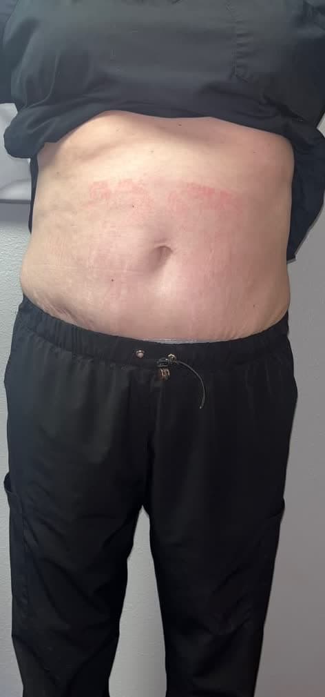Front view of a client's midsection before and after eight cryotherapy sessions (after)