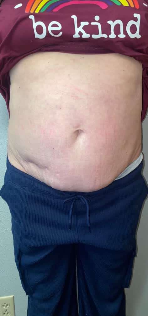 Front view of a client's midsection before and after eight cryotherapy sessions (before)