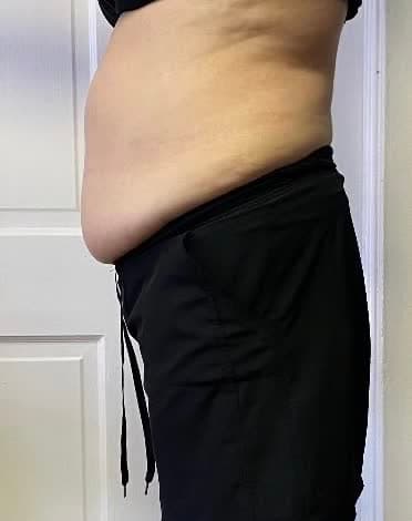 Side profile of a client's midsection before and after a 12-session cryotherapy core program (after)
