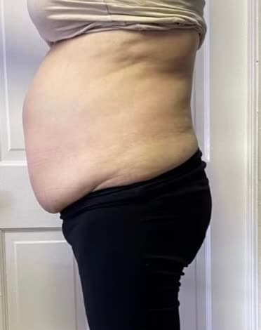 Side profile of a client's midsection before and after a 12-session cryotherapy core program (before)