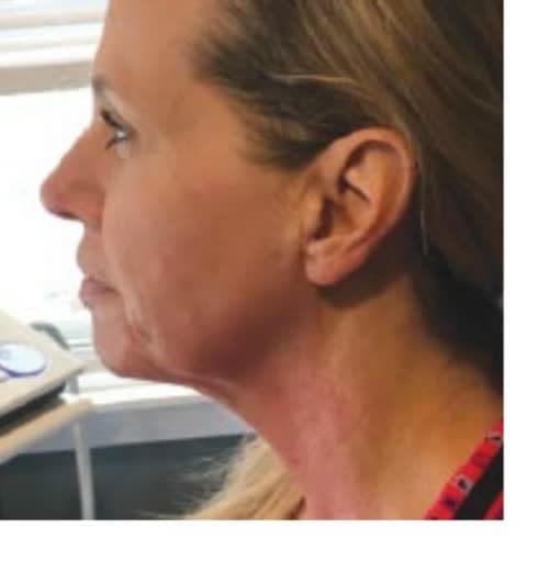 Profile of a client's jawline and neck before and after six cryotherapy sessions (after)