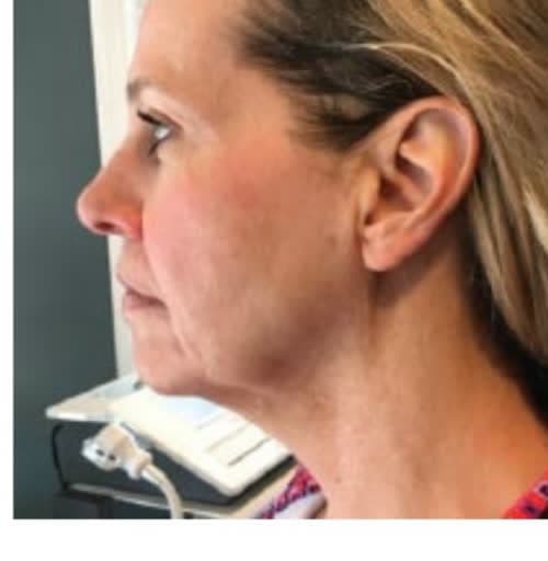Profile of a client's jawline and neck before and after six cryotherapy sessions (before)