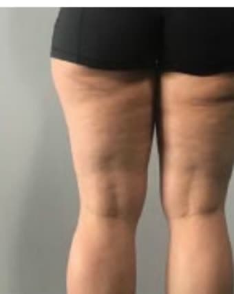Back of a client's thighs before and after eight cryotherapy sessions (after)