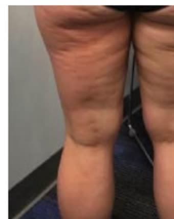 Back of a client's thighs before and after eight cryotherapy sessions (before)